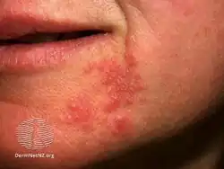 Perioral dermatitis