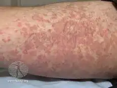 Pityriasis rosea