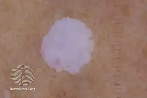 Polarised view of idiopathic guttate hypomelanosis