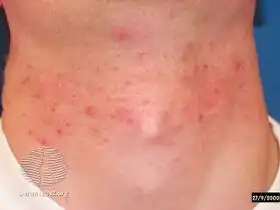 Pseudofolliculitis barbae
