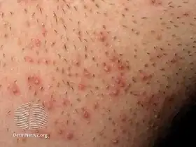 Pseudofolliculitis barbae