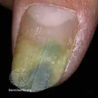 Pseudomonas infection