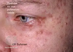 Pustules due to potassium iodide