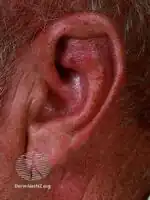 Relapsing polychondritis