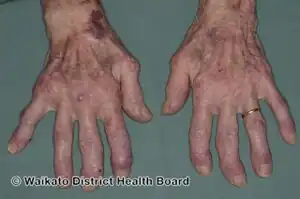 Rheumatoid arthritis