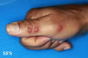 Rosai–Dorfman disease