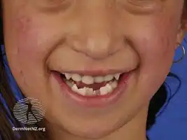 Rothmund-Thomson syndrome