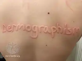 Dermographism