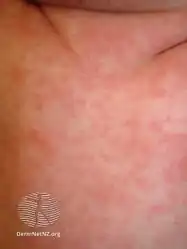 Roseola