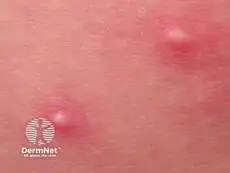Close up of hot tube folliculitis