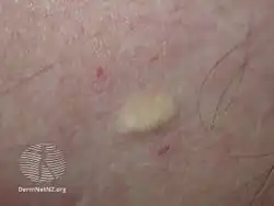 Steatocystoma multiplex