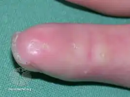 Systemic scleroderma