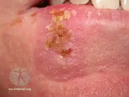 The following side effects can occur in the treated areas