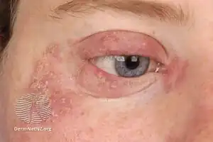 Tinea faciei: redness and scale