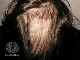 Trichotillomania