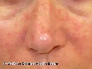 Zika virus infection