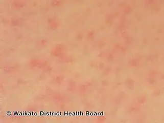 Zika virus infection