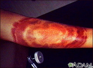 Lyme disease - erythema migrans Lyme disease - erythema migrans