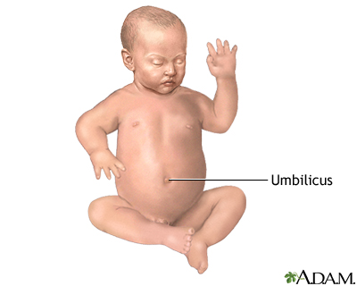 Umbilical hernia repair - series - Normal anatomy Umbilical hernia repair - series - Normal anatomy