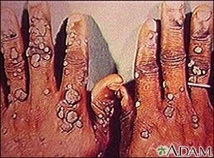 Warts, multiple - on hands Warts, multiple - on hands