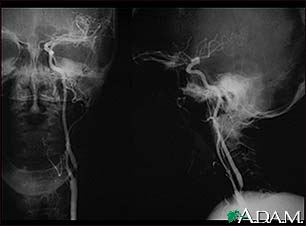 Carotid stenosis - X-ray of the left artery Carotid stenosis - X-ray of the left artery