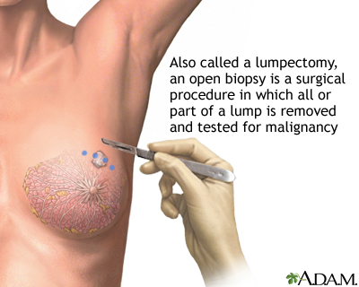 Open biopsy of the breast Open biopsy of the breast