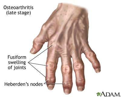 Osteoarthritis Osteoarthritis