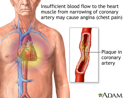 Stable angina