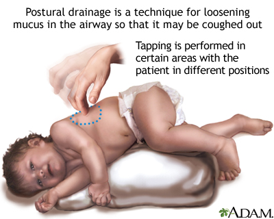 Postural drainage Postural drainage