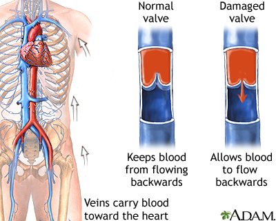 Venous insufficiency Venous insufficiency