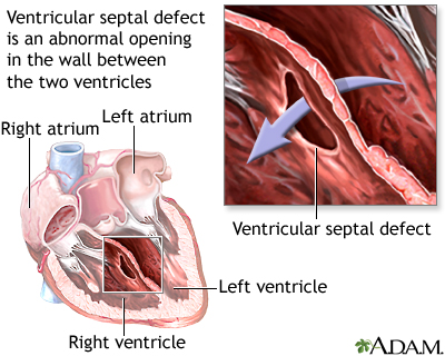 Ventricular septal defect Ventricular septal defect