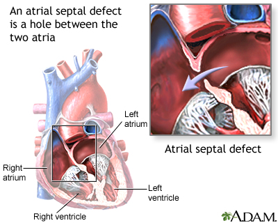 Atrial septal defect Atrial septal defect