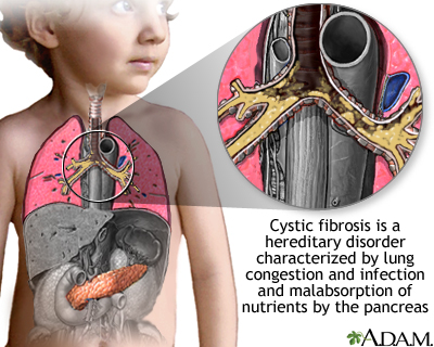 Cystic fibrosis Cystic fibrosis