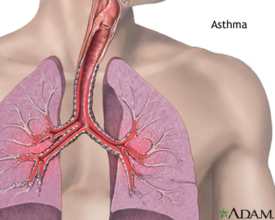 Asthma Asthma
