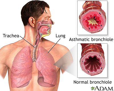 Asthmatic bronchiole and normal bronchiole Asthmatic bronchiole and normal bronchiole