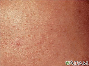 Blackheads (comedones) close-up Blackheads (comedones) close-up