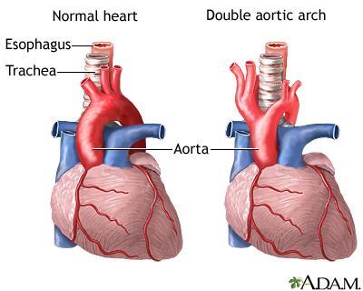 Double aortic arch Double aortic arch