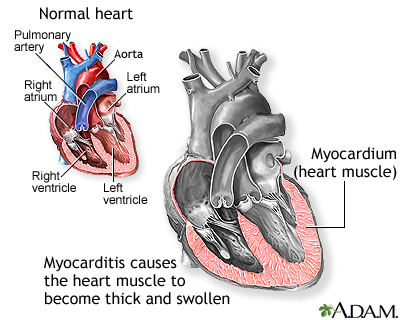 Myocarditis Myocarditis