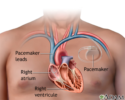 Pacemaker Pacemaker
