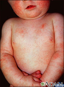 Dermatitis - atopic in an infant Dermatitis - atopic in an infant