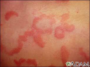 Hives (urticaria) - close-up Hives (urticaria) - close-up