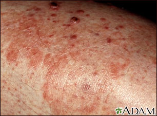 Granuloma - fungal (Majocchi's) Granuloma - fungal (Majocchi's)