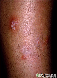 Granuloma - fungal (Majocchi's) Granuloma - fungal (Majocchi's)