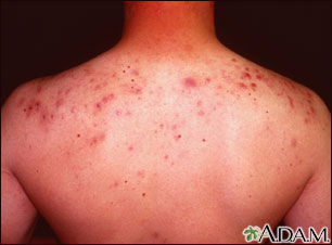 Acne - cystic on the back Acne - cystic on the back