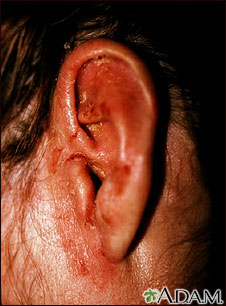 Tinea corporis - ear Tinea corporis - ear