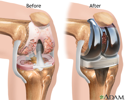 Knee joint replacement prosthesis Knee joint replacement prosthesis