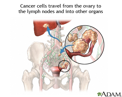 Ovarian cancer metastasis Ovarian cancer metastasis