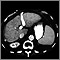 Liver cirrhosis - CT scan