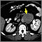 Lymph node metastases, CT scan Lymph node metastases, CT scan