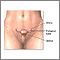 Pelvic laparoscopy - series Pelvic laparoscopy - series